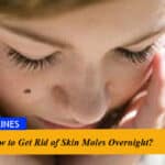How to Get Rid of Skin Moles Overnight?